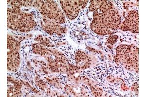 Immunohistochemistry (IHC) analysis of paraffin-embedded Human Mammary Cancer, antibody was diluted at 1:100. (EPAS1 anticorps  (Ser343))
