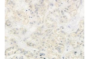 ABIN6263370 and ABIN6279022 at 1/100 staining human renal cell carcinoma by IHC-P. (MRPL37 anticorps  (N-Term))