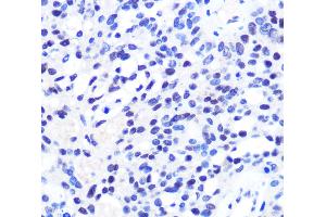 Immunohistochemistry of paraffin-embedded Human oophoroma using CHD4 Polyclonal Antibody at dilution of 1:100 (40x lens).