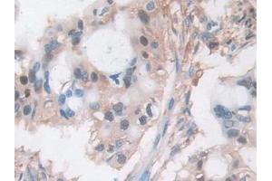 Detection of CFL1 in Human Bile duct cancer Tissue using Polyclonal Antibody to Cofilin 1 (CFL1)