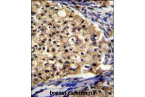SLC16A13 Antibody immunohistochemistry analysis in formalin fixed and paraffin embedded human breast carcinoma followed by peroxidase conjugation of the secondary antibody and DAB staining. (SLC16A13 anticorps  (C-Term))
