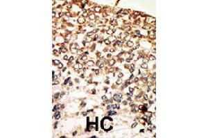 Formalin-fixed and paraffin-embedded human hepatocellular carcinoma tissue reacted with PRKACA polyclonal antibody  , which was peroxidase-conjugated to the secondary antibody, followed by AEC staining . (PRKACA anticorps  (N-Term))