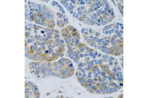 Immunohistochemistry of paraffin-embedded Human esophageal cancer using MBL2 antibody (ABIN6132334, ABIN6143597, ABIN6143600 and ABIN6221519) at dilution of 1:100 (40x lens). (MBL2 anticorps  (AA 21-248))