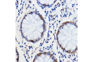 Immunohistochemistry of paraffin-embedded human colon carcinoma using GCAT antibody (ABIN7267461) at dilution of 1:100 (40x lens).