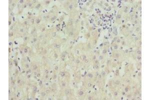 Immunohistochemistry of paraffin-embedded human liver cancer using ABIN7176363 at dilution of 1:100 (ZNF544 anticorps  (AA 1-230))