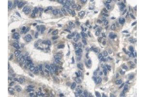 Detection of ErbB4 in Human Liver cancer Tissue using Polyclonal Antibody to Erb-b2 Receptor Tyrosine Kinase 4 (ErbB4)