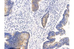 ABIN7094680 and ABIN7098731 at 1/100 staining Human colorectal cancer by IHC-P. (CLCA1 anticorps  (C-Term))