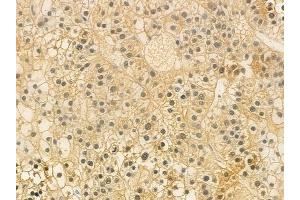 ABIN6259556 and ABIN6274915 at 1/100 staining human hepatocellular carcinoma by IHC-P. (GUSBP2 anticorps  (Internal Region))