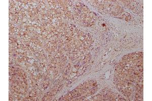 IHC image of ABIN7143869 diluted at 1:500 and staining in paraffin-embedded human liver cancer tissue performed on a Leica BondTM system.