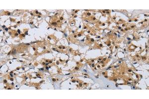 Immunohistochemistry of paraffin-embedded Human thyroid cancer tissue using CMTM8 Polyclonal Antibody at dilution 1:40 (CMTM8 anticorps)