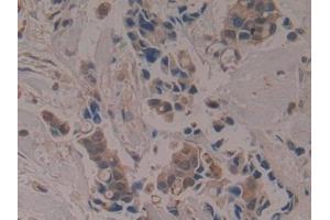 Detection of APOA1BP in Human Breast cancer Tissue using Polyclonal Antibody to Apolipoprotein A1 Binding Protein (APOA1BP)