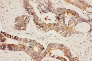 Anti-Hsp90-alpha-Picoband antibody,  IHC(P): Human Intestinal Cancer Tissue