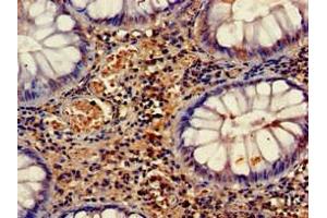 Immunohistochemistry of paraffin-embedded human colon cancer using ABIN7158660 at dilution of 1:100