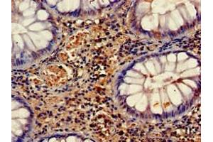 Immunohistochemistry of paraffin-embedded human colon cancer using ABIN7158660 at dilution of 1:100 (HELLS anticorps  (AA 550-600))