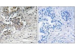 Immunohistochemistry analysis of paraffin-embedded human prostate carcinoma tissue, using Claudin 7 (Ab-210) Antibody. (Claudin 7 anticorps  (AA 162-211))
