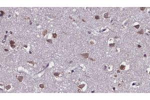 ABIN6275586 at 1/100 staining Human brain cancer tissue by IHC-P. (SLC28A2 anticorps  (Internal Region))