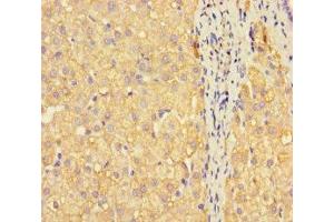 Immunohistochemistry of paraffin-embedded human liver cancer using ABIN7159675 at dilution of 1:100 (METTL7A anticorps  (AA 30-244))