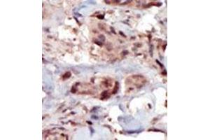 Formalin-fixed and paraffin-embedded human cancer tissue (breast carcinoma) reacted with the primary antibody, which was peroxidase-conjugated to the secondary antibody, followed by AEC staining.