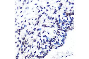 Immunohistochemistry of paraffin-embedded human esophageal cancer using POU2F1/POU2F1/OCT1 Rabbit mAb (ABIN7269495) at dilution of 1:100 (40x lens). (POU2F1 anticorps)