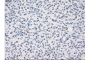 Immunohistochemical staining of paraffin-embedded Carcinoma of thyroid tissue using anti-FCGR2A mouse monoclonal antibody. (FCGR2A anticorps)