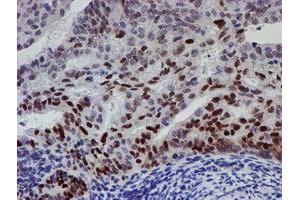Immunohistochemical staining of paraffin-embedded Adenocarcinoma of Human endometrium tissue using anti-UBE2E3 mouse monoclonal antibody. (UBE2E3 anticorps)