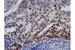 Immunohistochemical staining of paraffin-embedded Adenocarcinoma of Human endometrium tissue using anti-UBE2E3 mouse monoclonal antibody.