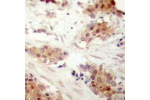 Immunohistochemical analysis of Cyclin D3 (pT283) staining in human breast cancer formalin fixed paraffin embedded tissue section. (Cyclin D3 anticorps  (C-Term, pSer283))