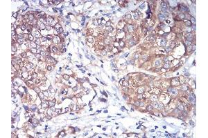 Immunohistochemical analysis of paraffin-embedded bladder cancer tissues using Rab1b mouse mAb with DAB staining.