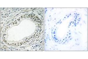 Immunohistochemistry analysis of paraffin-embedded human prostate carcinoma tissue, using RPL36 Antibody. (RPL36 anticorps  (AA 51-100))