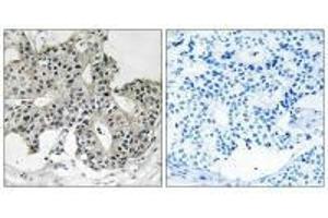 Immunohistochemistry analysis of paraffin-embedded human breast carcinoma tissue using PXMP3 antibody. (PEX2 anticorps  (N-Term))