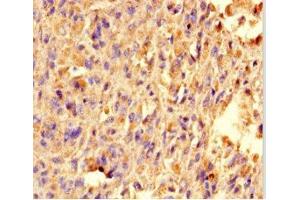 Immunohistochemistry of paraffin-embedded human melanoma using ABIN7172348 at dilution of 1:100 (TRAK1 anticorps  (AA 101-300))