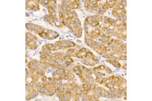 Immunohistochemistry of paraffin-embedded human liver cancer using G1 Rabbit mAb (ABIN7265718) at dilution of 1:50 (40x lens).