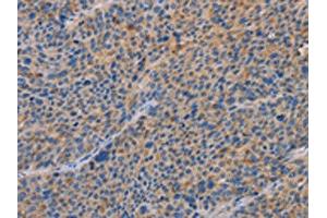 The image on the left is immunohistochemistry of paraffin-embedded Human liver cancer tissue using ABIN7192619(SPAG6 Antibody) at dilution 1/30, on the right is treated with synthetic peptide.