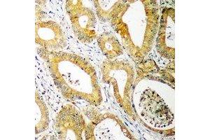 Immunohistochemical analysis of UBE2C staining in human colon cancer formalin fixed paraffin embedded tissue section.