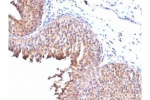 IHC testing of FFPE human bladder carcinoma with Keratin 10 antibody (clone KRT10/844).