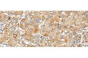 Immunohistochemistry of paraffin-embedded Human liver cancer tissue using CRABP1 Polyclonal Antibody at dilution of 1:120(x200)