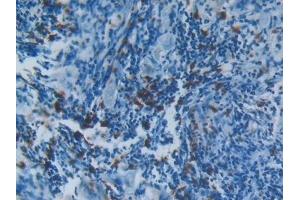 Detection of S100A8 in Human Lung cancer Tissue using Polyclonal Antibody to S100 Calcium Binding Protein A8 (S100A8)