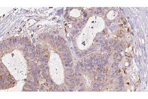 ABIN6272979 at 1/100 staining Human liver cancer tissue by IHC-P. (RAB3D anticorps  (Internal Region))