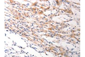 The image on the left is immunohistochemistry of paraffin-embedded Human lung cancer tissue using ABIN7191245(KRT6A/KRT6B/KRT6C Antibody) at dilution 1/40, on the right is treated with synthetic peptide. (KRT6A/KRT6B/KRT6C anticorps)