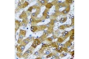 Immunohistochemical analysis of AMCase staining in human liver cancer formalin fixed paraffin embedded tissue section. (CHIA anticorps)