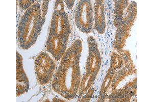 Immunohistochemistry of Human ovarian cancer using RHEB Polyclonal Antibody at dilution of 1:30