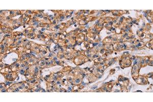 Immunohistochemistry of paraffin-embedded Human prostate cancer tissue using ARAP1 Polyclonal Antibody at dilution 1:40