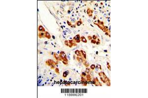 Formalin-fixed and paraffin-embedded human hepatocarcinoma with CEACAM Antibody (N-term), which was peroxidase-conjugated to the secondary antibody, followed by DAB staining. (CEACAM5 anticorps  (N-Term))