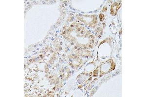Immunohistochemistry of paraffin-embedded human thyroid cancer using PP2A-B56δ/PR61δ/PP2A-B56δ/PR61δ/PPP2R5D antibody (ABIN7269690) at dilution of 1:100 (40x lens).