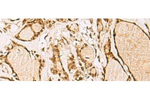 Immunohistochemistry of paraffin-embedded Human thyroid cancer tissue using NIPBL Polyclonal Antibody at dilution of 1:55(x200) (NIPBL anticorps)