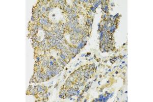 Immunohistochemistry of paraffin-embedded human colon carcinoma using IDH2 antibody. (IDH2 anticorps)