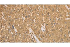 Immunohistochemistry of paraffin-embedded Human liver cancer tissue using CD40 Polyclonal Antibody at dilution 1:70 (CD40 anticorps)