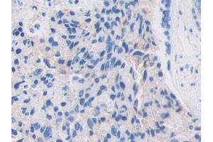 Detection of PZP in Human Prostate cancer Tissue using Polyclonal Antibody to Pregnancy Zone Protein (PZP)