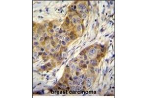 ANR39 Antibody (C-term) (ABIN655104 and ABIN2844736) immunohistochemistry analysis in formalin fixed and paraffin embedded human breast carcinoma followed by peroxidase conjugation of the secondary antibody and DAB staining. (ANKRD39 anticorps  (C-Term))