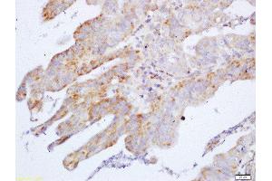 Formalin-fixed and paraffin embedded human gastric carcinoma labeled with Anti-Cyclin M2 Polyclonal Antibody, Unconjugated  at 1:200 followed by conjugation to the secondary antibody and DAB staining (Cyclin M2 anticorps  (AA 51-150))